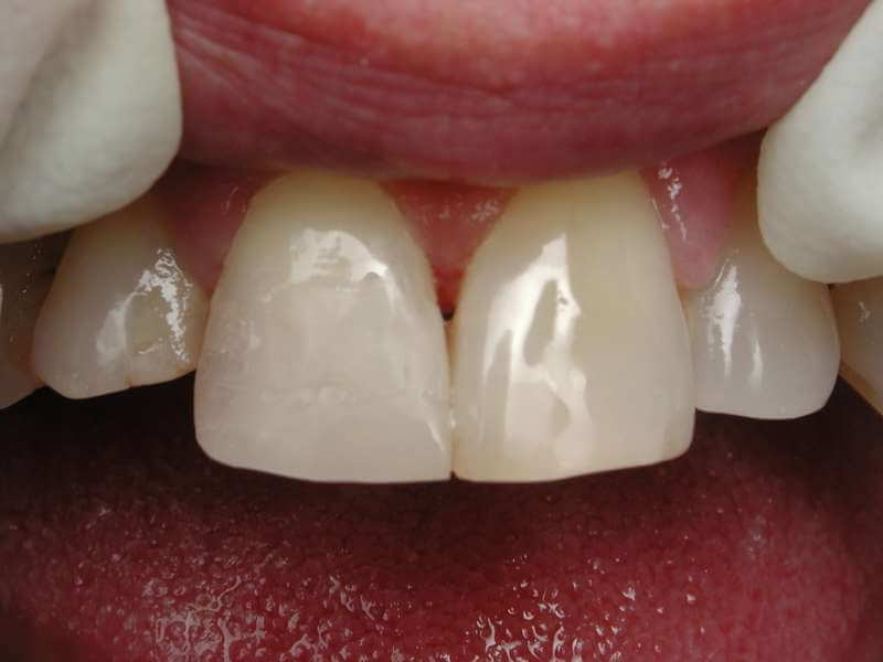 השלמת השיניים עם חומר מרוכב