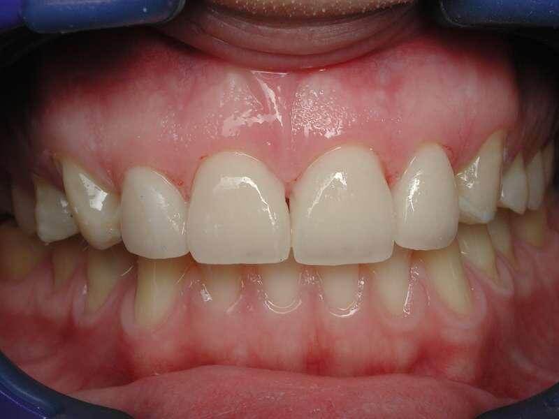 ציפוי חרסינה לשיניים