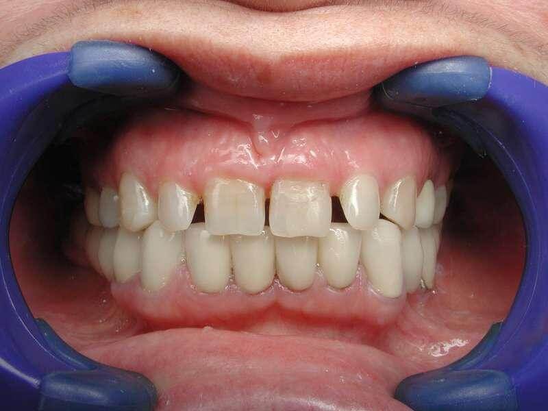 ציפוי חרסינה לשיניים