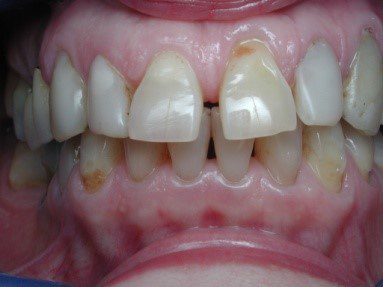 סגירת רווח בשיניים