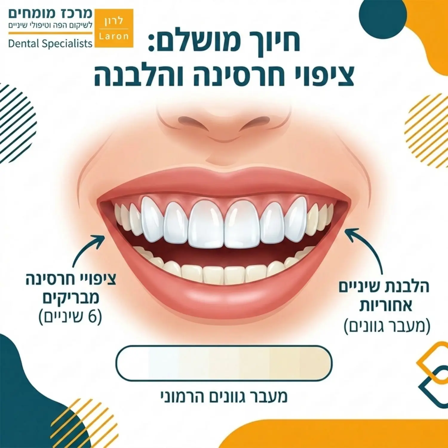 איור המדגים חיוך רחב שבו 6 השיניים הקדמיות עליונות מכוסות בציפויי חרסינה מבריקים בעוד השיניים האחוריות עוברות תהליך הלבנה להשוואת גוונים, עם חצים המצביעים על המעבר ההרמוני של הצבעים לאורך קשת השיניים