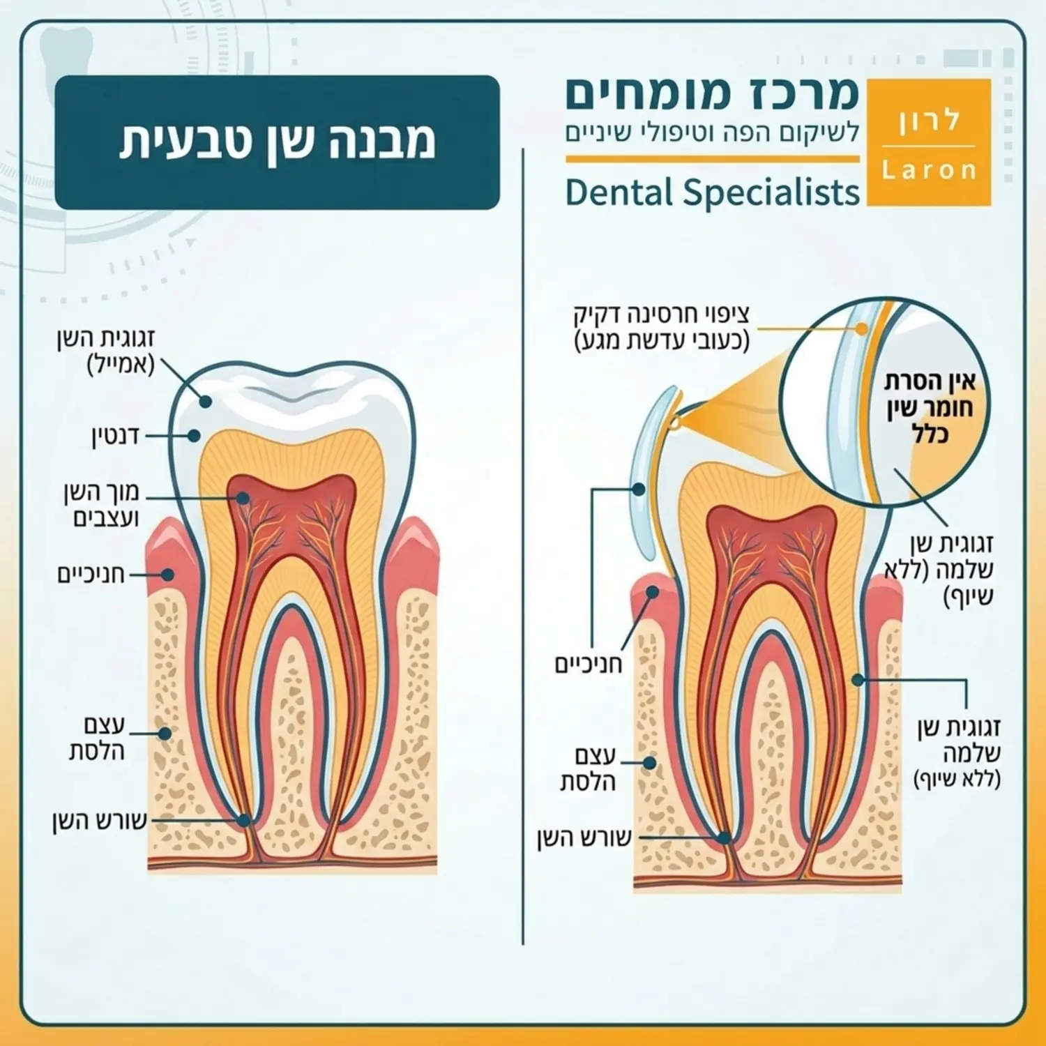 אינפוגרפיקה המציגה חתך צד של שן טבעית ולצידה הדמיה של ציפוי חרסינה דקיק בעובי של עדשת מגע, המונח על השן ללא הסרת חומר שן כלל