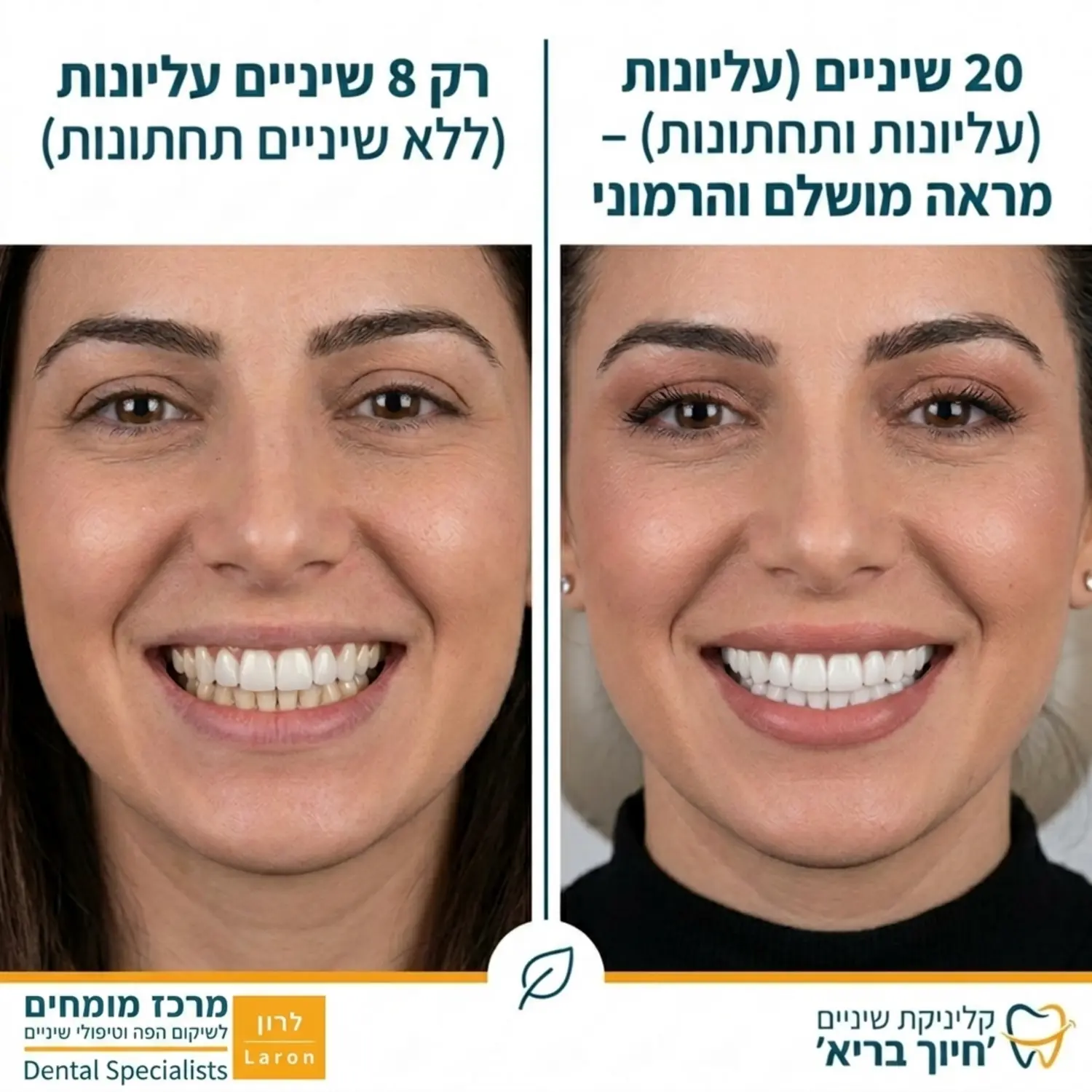 תמונת השוואה המחולקת לשניים. בחצי הראשון מטופל עם ציפוי על 8 שיניים עליונות בלבד, ובחצי השני אותו מטופל עם ציפוי של 20 שיניים עליונות ותחתונות. התמונה צריכה להמחיש את ההבדל בהרמוניה ובאחידות הצבע בין שתי הלסתות.