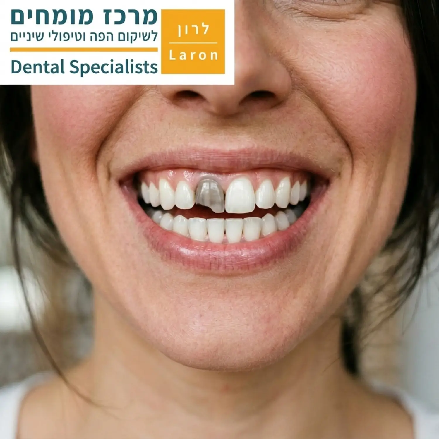 צילום קלוז אפ של חיוך נשי שבו שן קדמית אחת כהה או שבורה במקצת לעומת שאר השיניים הלבנות והבריאות
