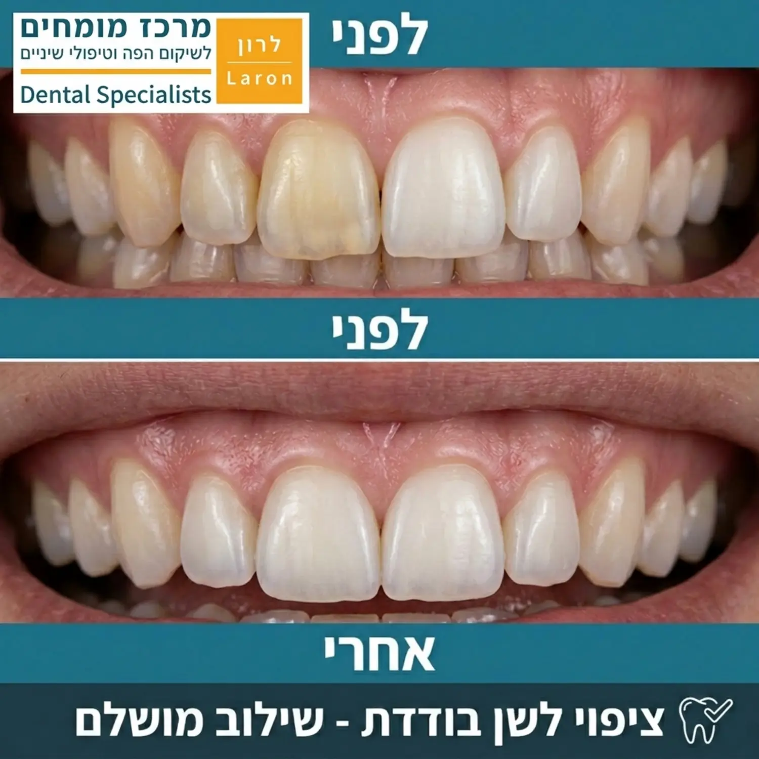 תמונת לפני ואחרי של חיוך בו בוצע ציפוי לשן בודדת, המדגישה את ההשתלבות המושלמת עם השיניים הסמוכות