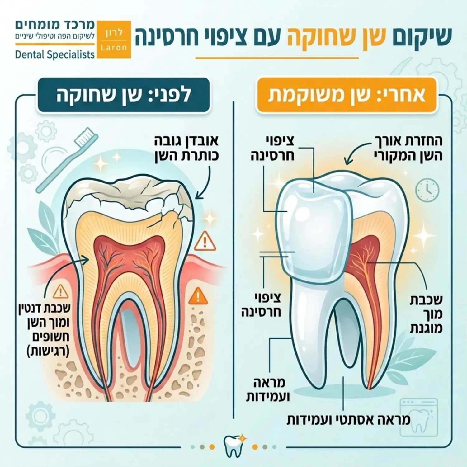 אינפוגרפיקה המציגה שן שחוקה (לפני) לעומת שן ששוקמה באמצעות ציפוי חרסינה (אחרי). האינפוגרפיקה ממחישה כיצד הציפוי מחזיר לשן את אורכה המקורי ומגן על שכבת המוך הרגישה שנחשפה עקב השחיקה