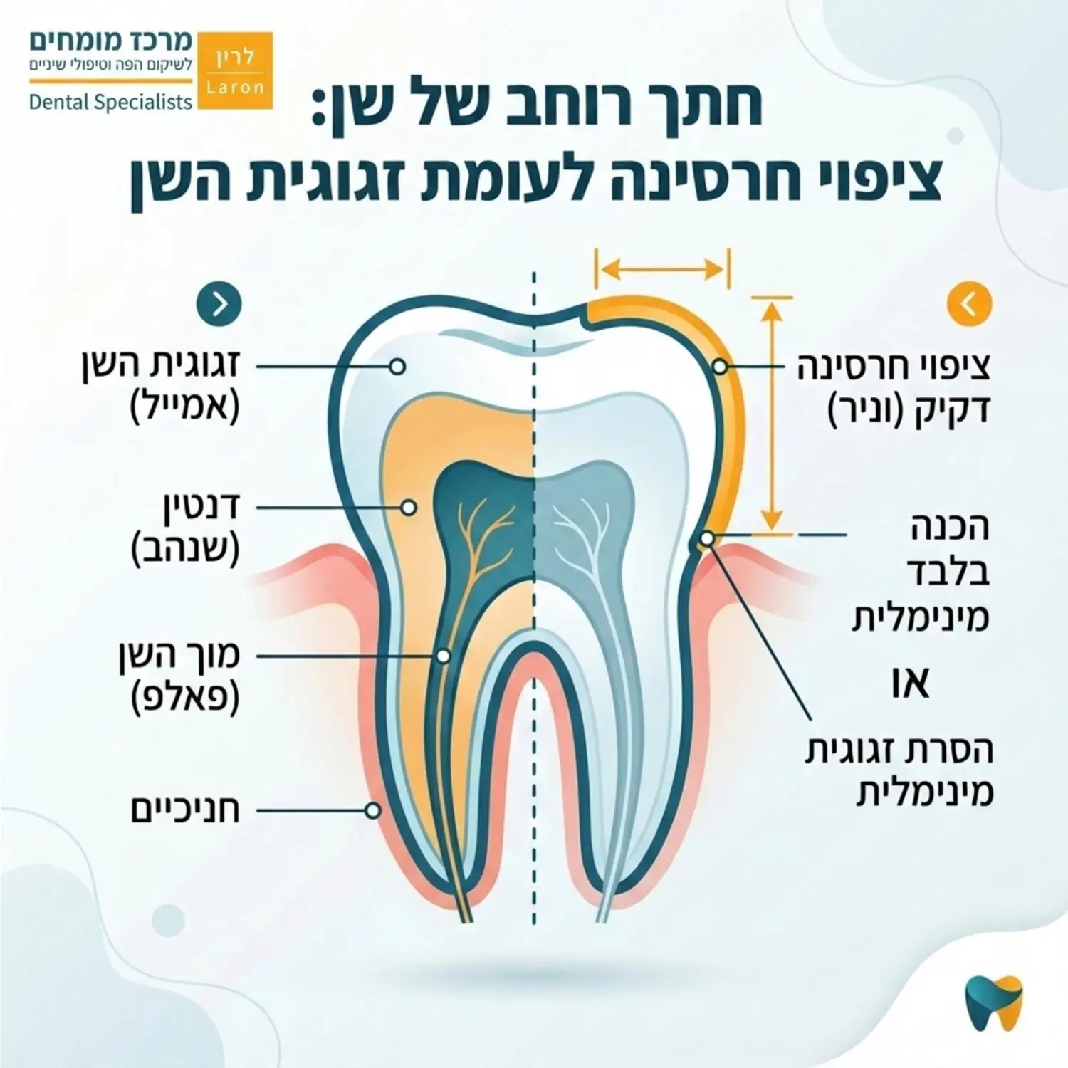אינפוגרפיקה רפואית המציגה חתך רוחב של שן, המדגימה את ההסרה המינימלית של זגוגית השן (אמייל) לעומת העובי הדקיק של ציפוי החרסינה המודבק עליה, בצבעים רכים וברורים.