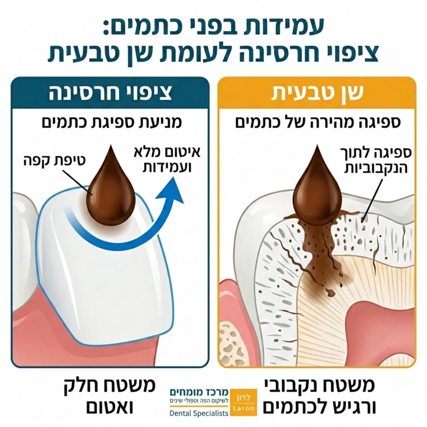 אינפוגרפיקה חזותית המדגימה טיפת קפה המחליקה על פני שטח חלק של ציפוי חרסינה לעומת ספיגה בנקבוביות של שן טבעית, להמחשת העמידות בפני כתמים.
