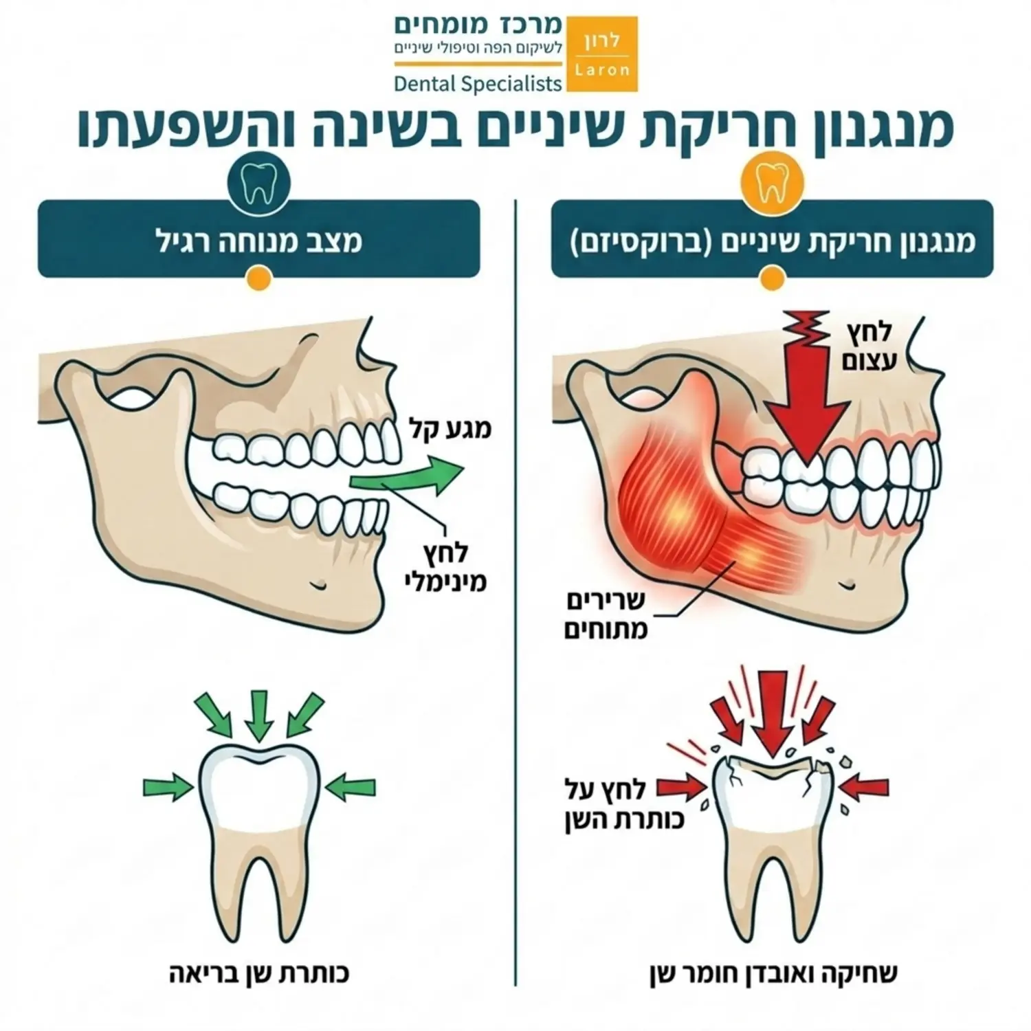 אינפוגרפיקה מקצועית המציגה את מנגנון פעולת הלסת בזמן חריקת שיניים בשינה (ברוקסיזם), הכוללת הדמיה של הלחץ המופעל על כותרת השן לעומת מצב מנוחה רגיל