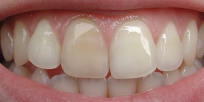 ציפוי שיניים זירקוניה