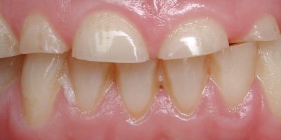 ציפוי שיניים זירקוניה